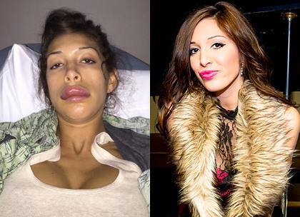 Pasca Bibir Jontor karena Suntik, Farrah Abraham Kini Sudah Cantik Lagi