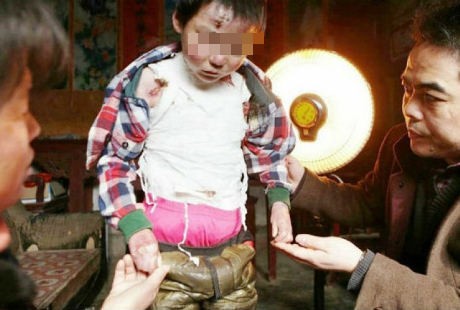 Akibat Kondisi Langka, Kulit Bocah Ini Sangat Rapuh dan Sakit Saat Disentuh