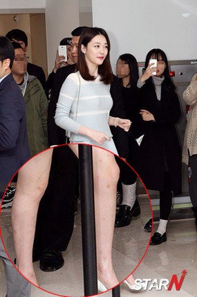 Banyak Bekas Suntikan di Kaki Sulli f(x), Ada Apa?