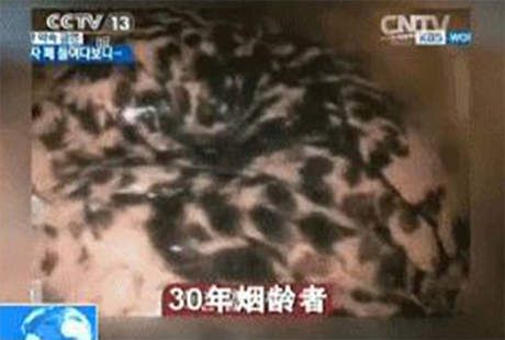 Hiii... Seramnya Video Paru-paru Rusak Akibat Rokok