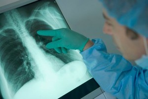 Kanker Paru Geser Kanker Payudara, Pembunuh Wanita No 1 di Negara Maju