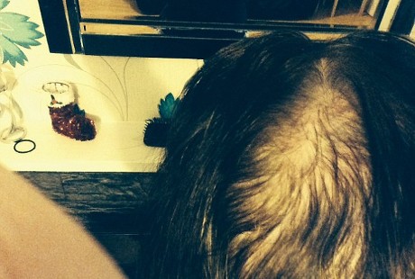 Ketagihan Warnai Rambut, Kepala Ibu Muda Ini Terancam Botak