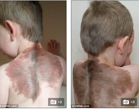 Penyakit Langka Bikin Bocah Ini Seperti Punya Sayap