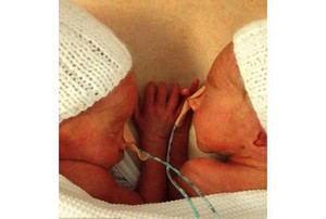 So Sweet! Bayi Kembar Ini Saling Berpegangan ketika Disatukan Kembali