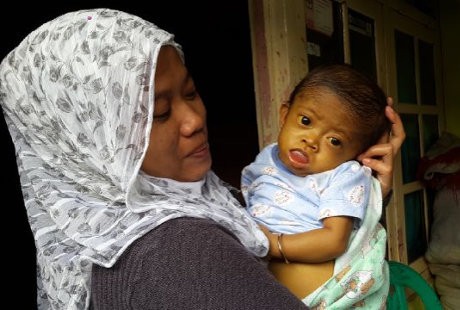 Perut Membesar, Anak Tukang Parkir di Kemayoran Idap Atresia Bilier