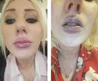 bibir サスペンダー （MELOTOUGH Suspender lebar 1.5/2 inci