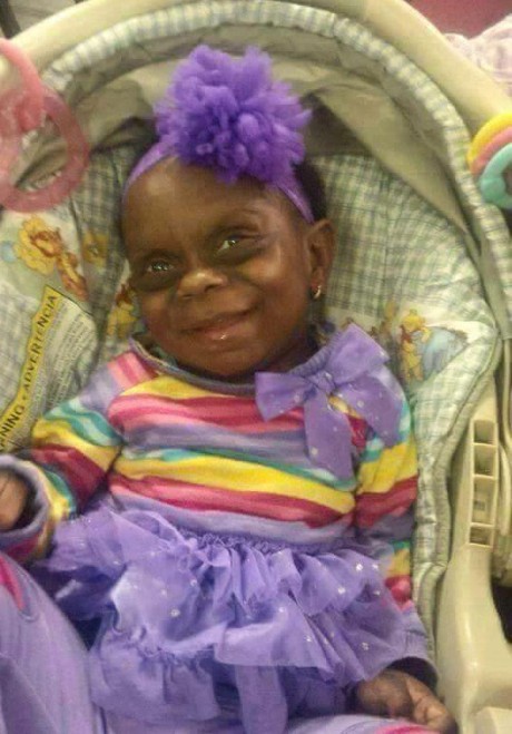 Tega! Foto Balita yang Sakit Langka Ini Malah Dijadikan Lelucon di Internet