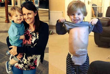 Lahir Tanpa Anus, Theo Tetap Ceria Meski ke Mana-mana Bawa Kantung Kolostomi