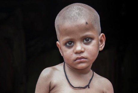 Kisah Bocah Laki-laki yang Terkena Sindrom Doyan Makan Rambut