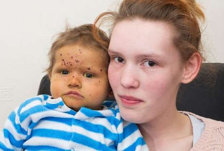 Sakit Liver Langka, Bocah Ini Gatal-gatal Sejak Bayi