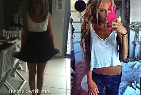 Obsesi Kurus Ala Miranda Kerr, Gadis Ini Anoreksia dan Bobotnya Hanya 30 Kg