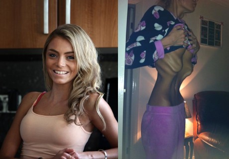 Kurus Kering karena Cuma Makan Satu Apel Sehari, Beth Kini Lawan Anoreksia