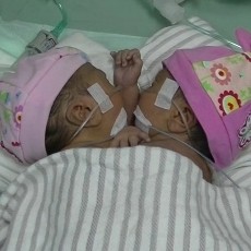 Bayi Kembar Siam ke-68 asal Sidoarjo Dirawat di RSU Soetomo