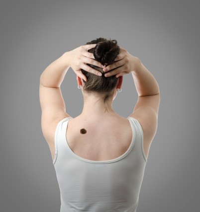 Tanda Lahir Unik, Tak Selamanya Harus Dihilangkan