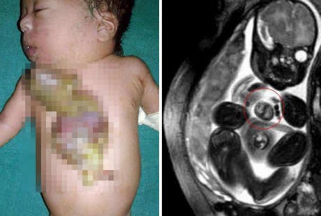 Bayi Ini Lahir dengan Jantung di Luar Tubuhnya