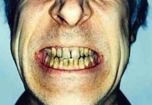 Sleep Bruxism, Gigi Gemerutuk Saat Tidur