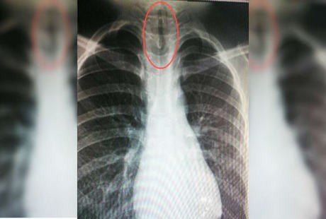 Dikira Radang, Ternyata Ada Lintah di Tenggorokan Bocah Ini