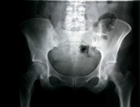 Menyoal Cedera pada Selangkangan, Tak Hanya Lazim pada Atlet