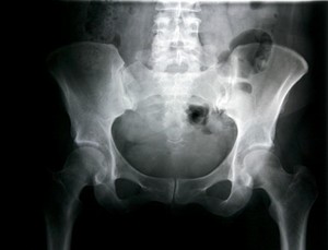 Hati-hati Ini Dampaknya Jika Anda Mengalami Cedera Selangkangan