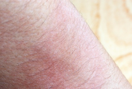 Bocah 8 Tahun Ini Tiba-tiba Alergi Parah Gara-gara Transfusi Darah