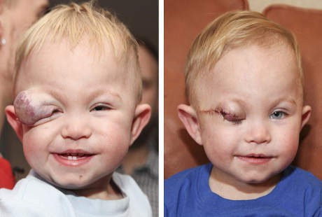 Punya Tanda Lahir Nyaris Menutupi Mata, Bocah Ini Akhirnya Dioperasi