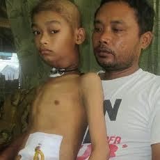 Anak Penderita Kanker Laring di Situbondo ini Belum Ada Perhatian Pemerintah