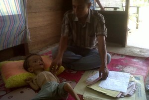 Derita Bocah 3 Tahun Mengidap Hidrosefalus, Kepala Membesar Tubuh Mengecil