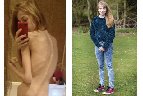 Makan 200 Kalori Sehari karena Anoreksia, Bobot Emma Pernah Hanya 31 Kg