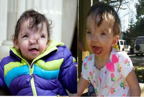 Kondisi Langka Bikin Wajah Tak Beraturan, Kini Violet Bisa Tersenyum