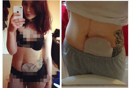 Kisah Hattie, Tetap Percaya Diri Meski Harus Pakai Kantong Ostomy