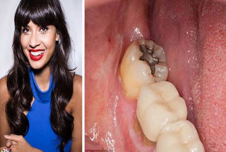 Langka, Jameela Diduga Keracunan Merkuri karena Tambalan Gigi