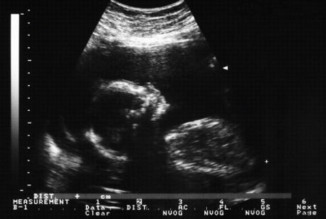 Ilmuwan Tiongkok Lakukan Rekayasa Genetik Pada Embrio Manusia