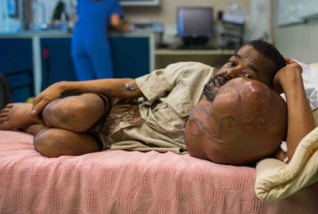 Tumor Seberat 7,2 Kg di Pipi Pria Ini Akhirnya Berhasil Diangkat