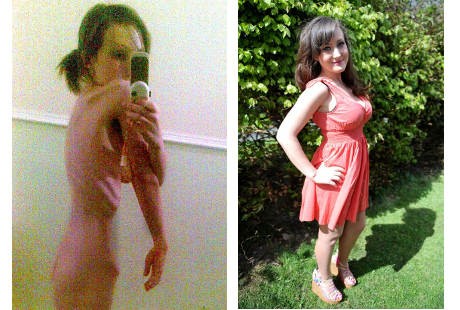 Sempat Berbobot 24 Kg karena Idap Anoreksia, Kini Megan Sukses Jadi Model