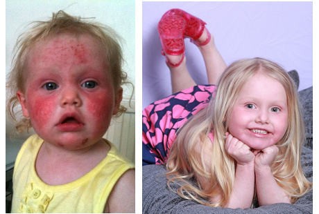 Alergi Langka, Tubuh Bocah Ini Bisa Memerah Jika Kena Sinar Matahari