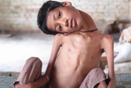 Potret Mahendra, Bocah dengan Leher 'Menggantung' dan Tak Bisa Tegak