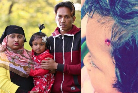 Kepala Tertembak Senapan Angin, Bocah Ini Diselamatkan Rambut Tebalnya