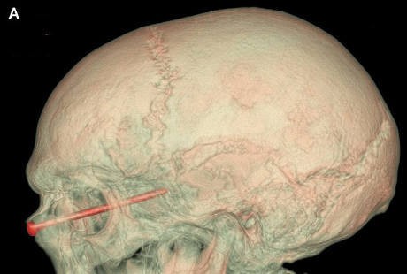 Paku Tertancap di Dekat Mata, Untunglah Penglihatan Pria Ini Baik-baik Saja