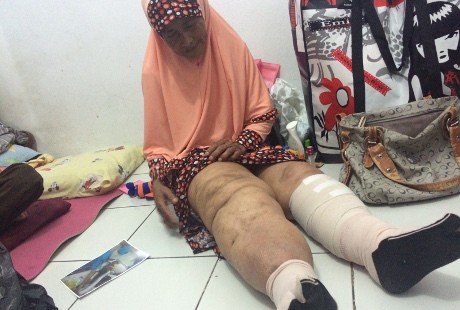 Puluhan Tahun Mengidap Kaki Gajah, Nenek Komariah Butuh Uluran Tangan