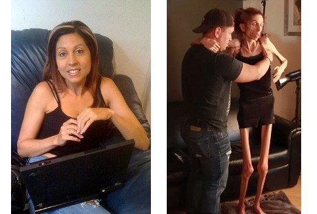 Idap Anoreksia Hingga Bobotnya 18 Kg, Rachael Cari Bantuan Lewat Youtube