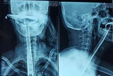 Ingin Redakan Radang Tenggorokan, Ibu Ini Malah Tersedak Spatula