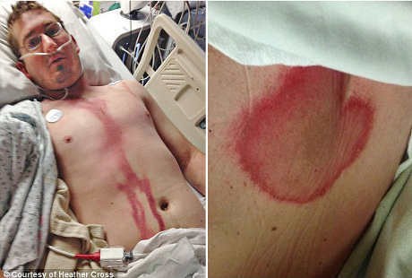 Tersambar Petir Tepat di Kepala, Pria Ini Selamat