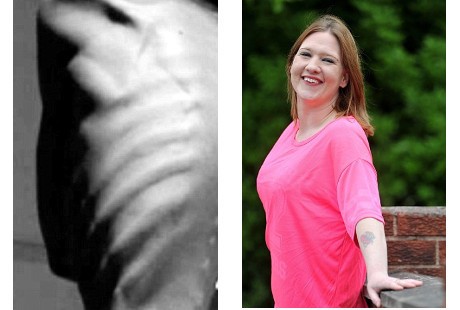 Idap Bulimia, Bobot Katie Sempat Hanya 24 Kg dan Alami Gagal Jantung