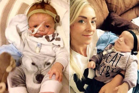 Kisah Ibu yang Dikaruniai Bayi Berwajah Tak Sempurna Karena Sindrom Langka