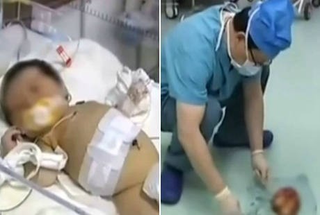 Dokter di Tiongkok Sukses Angkat Kembar Parasit dari Perut Bayi Ini