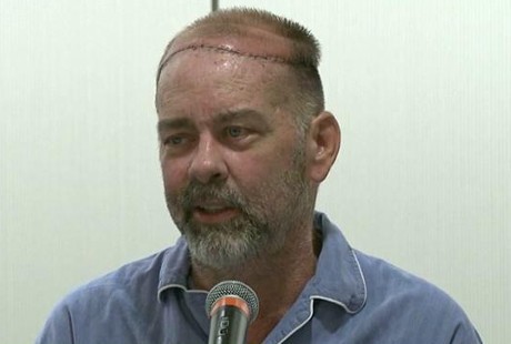 Transplantasi Tengkorak Pertama Sukses Dilakukan di Texas