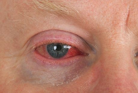 Usai Lari Marathon di Cuaca Dingin, Kornea Pria 44 Tahun Membeku