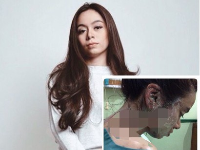 Muka Mulus Lagi Setelah Disiram Air Keras, Fabioli Habiskan Rp 70 Juta
