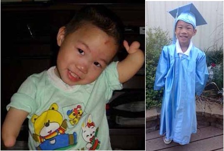 Kisah Mei, Bocah Lelaki yang Terlahir Tanpa Jari Tangan dan Kaki