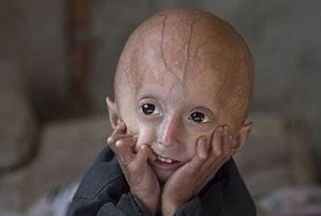 Anak-anak yang Menua Sebelum Waktunya